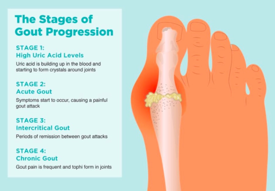 Gout-Symptoms-Causes-and-Prevention-02.jpg